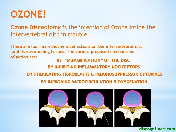 OZONE! Ozone Discectomy is the injection of Ozone inside the intervertebral disc in trouble