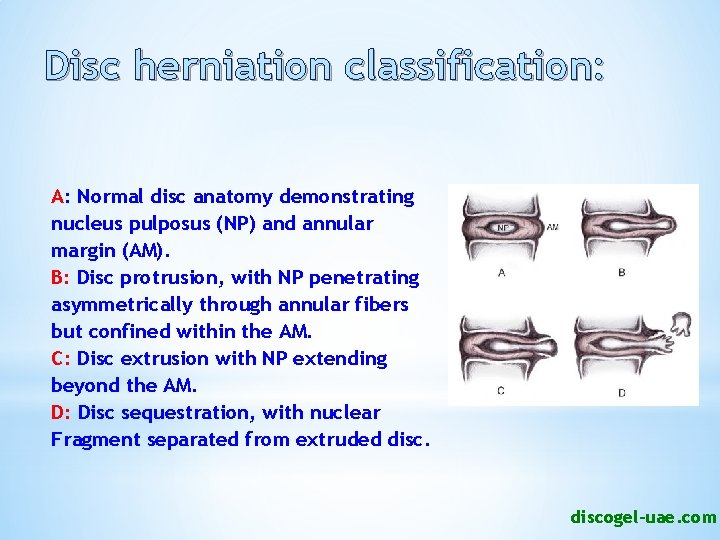 Disc herniation classification: A: Normal disc anatomy demonstrating nucleus pulposus (NP) and annular margin