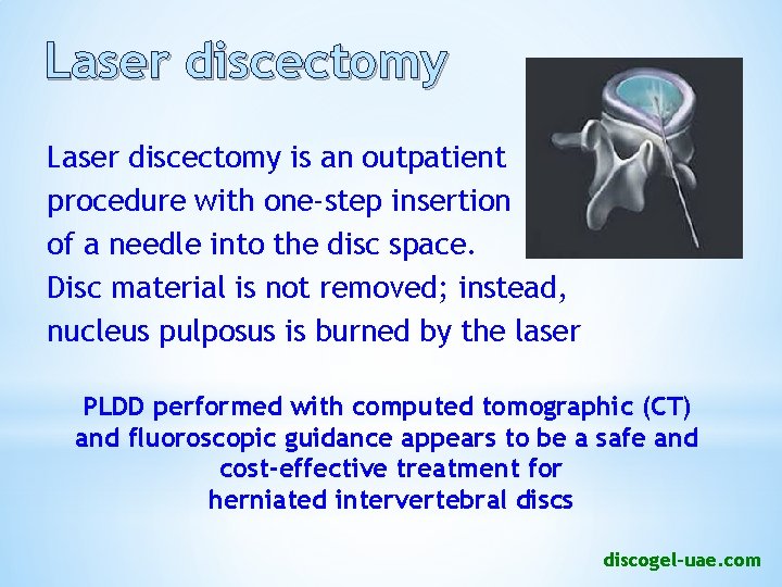 Laser discectomy is an outpatient procedure with one-step insertion of a needle into the