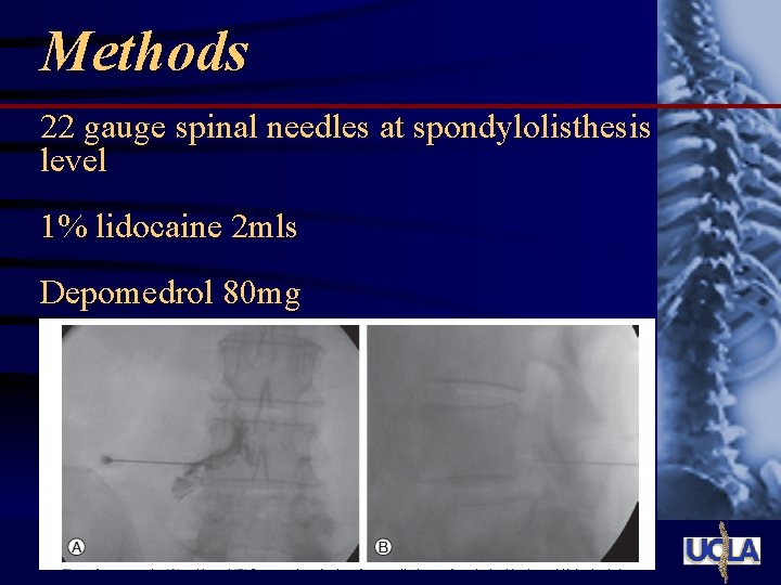 Methods 22 gauge spinal needles at spondylolisthesis level 1% lidocaine 2 mls Depomedrol 80