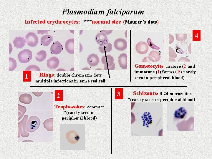 Plasmodium falciparum Infected erythrocytes: ***normal size (Maurer’s dots) 4 2 1 Gametocytes: mature (2)and