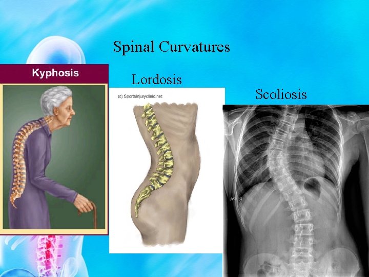 Spinal Curvatures Lordosis Scoliosis 