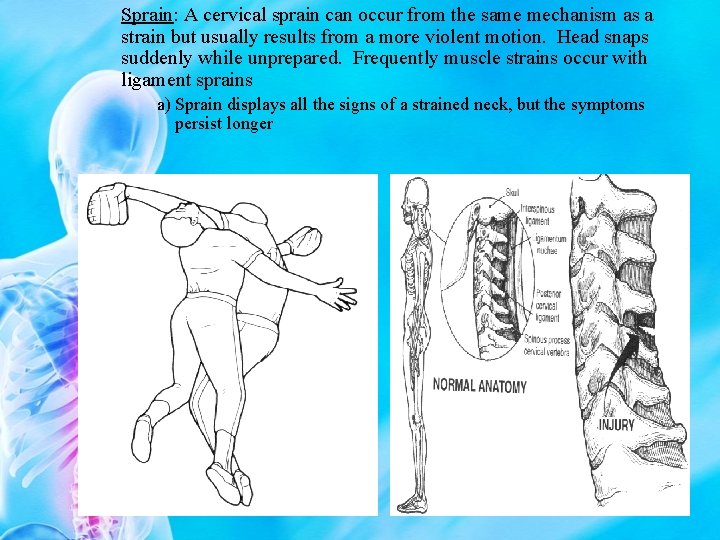 Sprain: A cervical sprain can occur from the same mechanism as a strain but