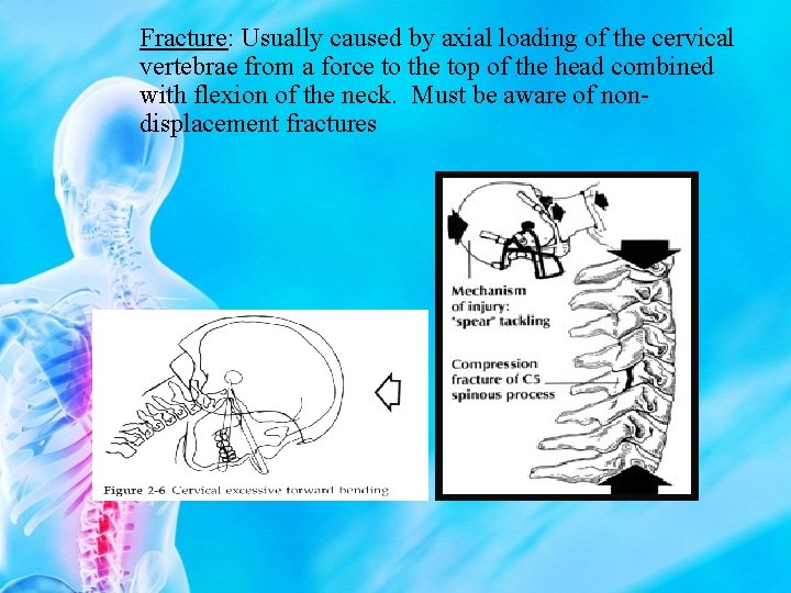 Fracture: Usually caused by axial loading of the cervical vertebrae from a force to