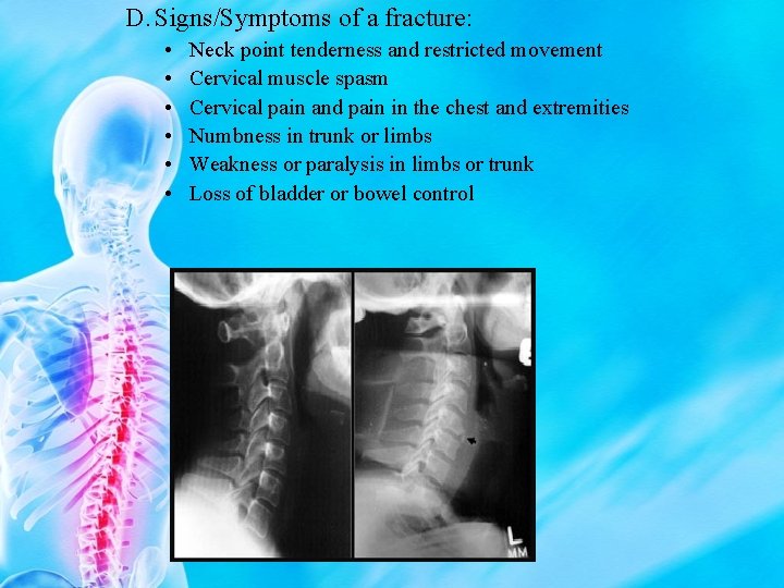 D. Signs/Symptoms of a fracture: • • • Neck point tenderness and restricted movement