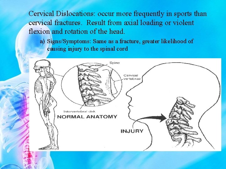 Cervical Dislocations: occur more frequently in sports than cervical fractures. Result from axial loading