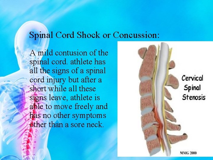 Spinal Cord Shock or Concussion: A mild contusion of the spinal cord. athlete has