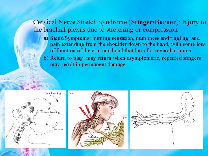 Cervical Nerve Stretch Syndrome (Stinger/Burner): Injury to the brachial plexus due to stretching or