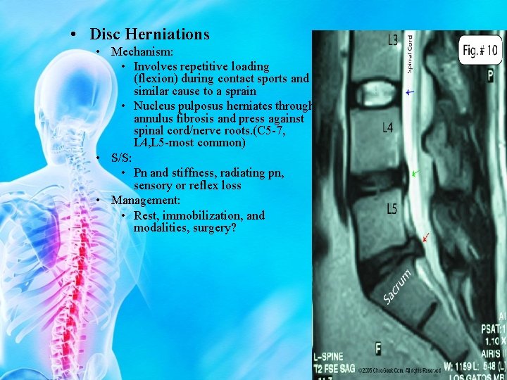  • Disc Herniations • Mechanism: • Involves repetitive loading (flexion) during contact sports