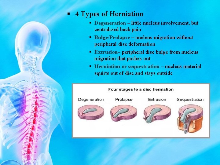 § 4 Types of Herniation § Degeneration – little nucleus involvement, but centralized back