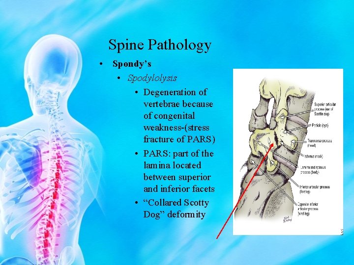 Spine Pathology • Spondy’s • Spodylolysis • Degeneration of vertebrae because of congenital weakness-(stress