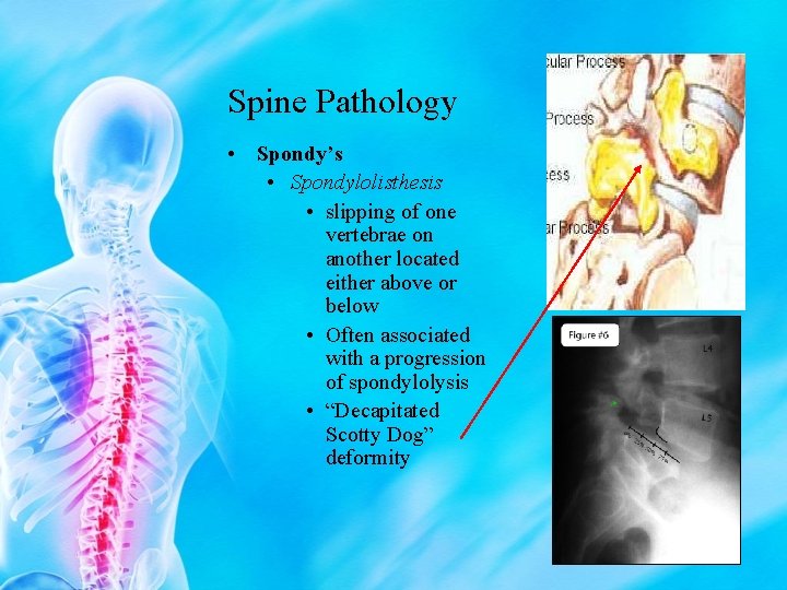 Spine Pathology • Spondy’s • Spondylolisthesis • slipping of one vertebrae on another located