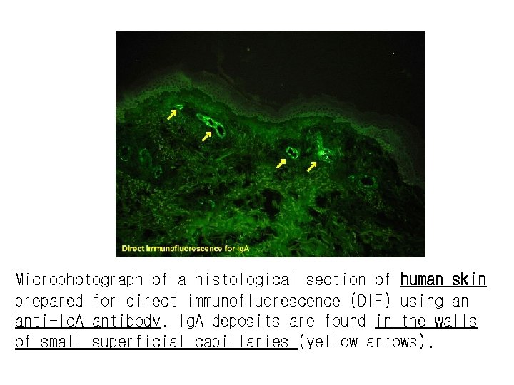 Microphotograph of a histological section of human skin prepared for direct immunofluorescence (DIF) using