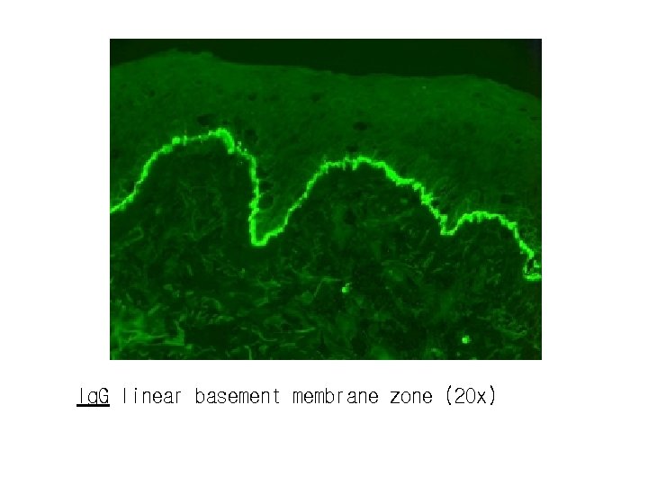 Ig. G linear basement membrane zone (20 x) 