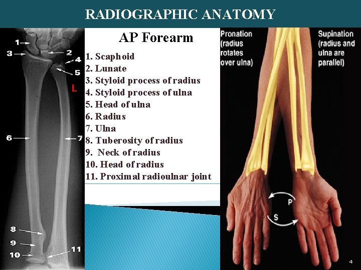 RADIOGRAPHIC ANATOMY AP Forearm 1. Scaphoid 2. Lunate 3. Styloid process of radius L
