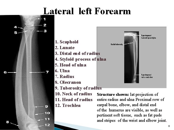 Lateral left Forearm 1. Scaphoid 2. Lunate 3. Distal end of radius 4. Styloid