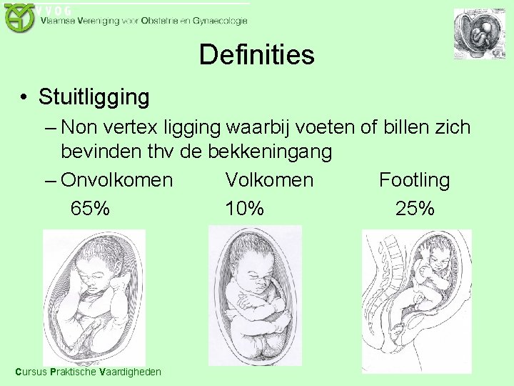 Definities • Stuitligging – Non vertex ligging waarbij voeten of billen zich bevinden thv