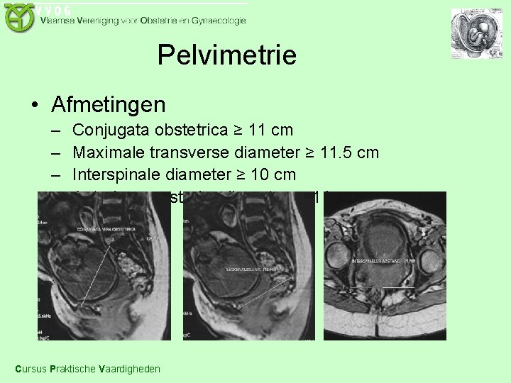 Pelvimetrie • Afmetingen – – Conjugata obstetrica ≥ 11 cm Maximale transverse diameter ≥