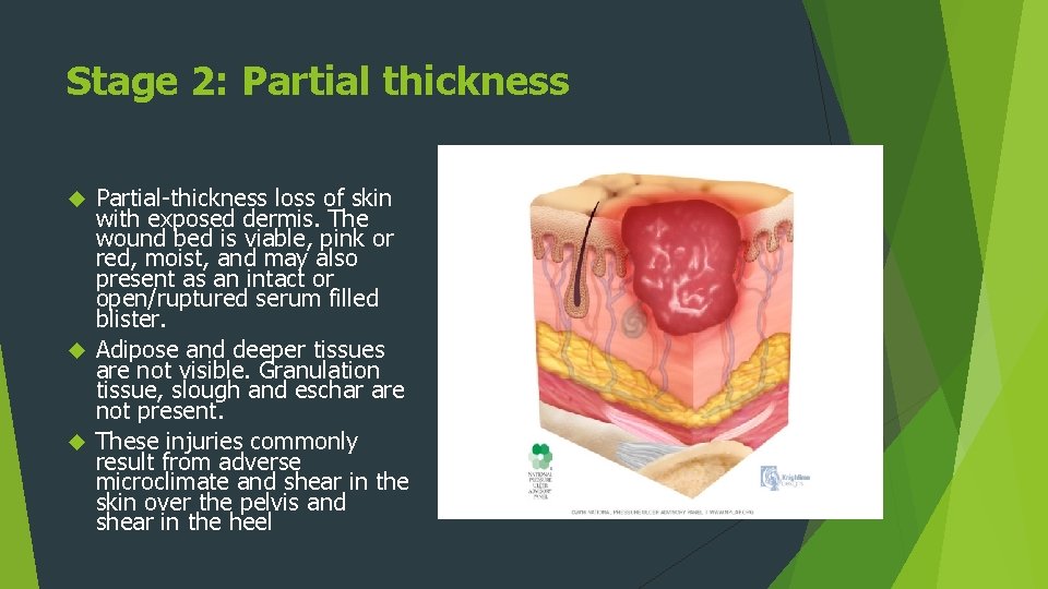 Stage 2: Partial thickness Partial-thickness loss of skin with exposed dermis. The wound bed