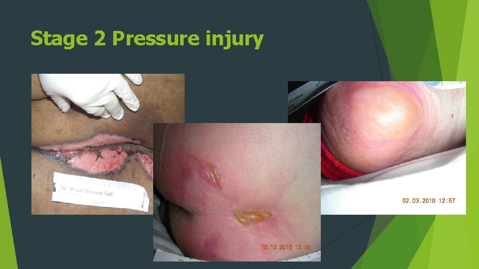 Stage 2 Pressure injury 