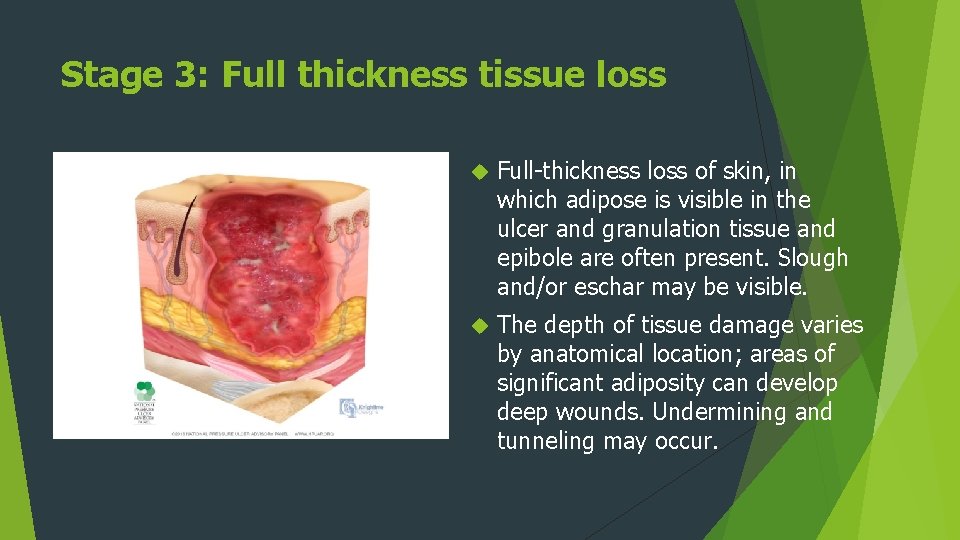 Stage 3: Full thickness tissue loss Full-thickness loss of skin, in which adipose is