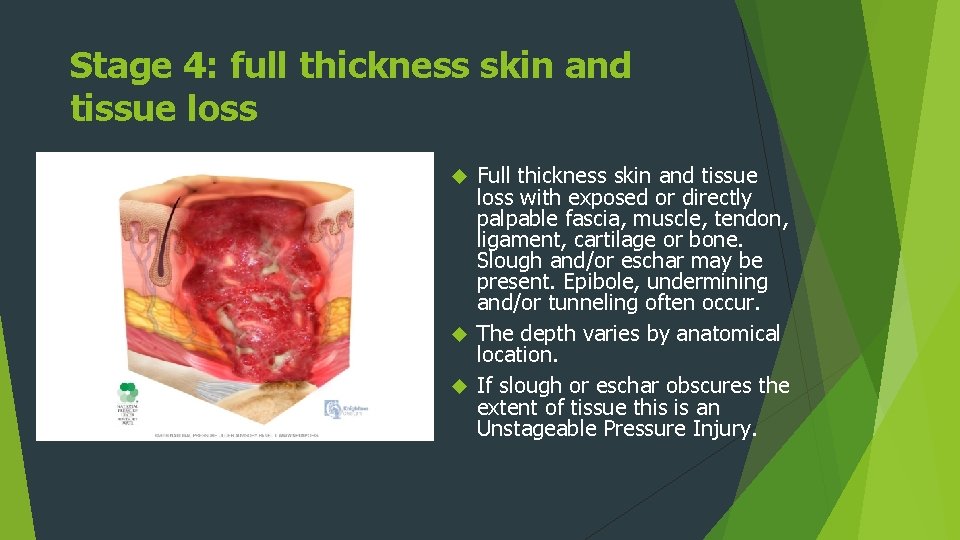 Stage 4: full thickness skin and tissue loss Full thickness skin and tissue loss