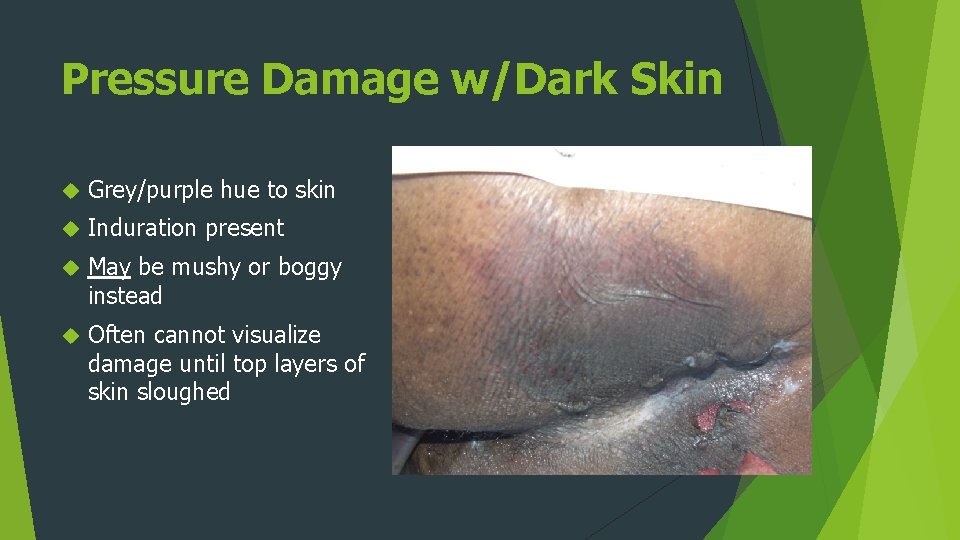 Pressure Damage w/Dark Skin Grey/purple hue to skin Induration present May be mushy or