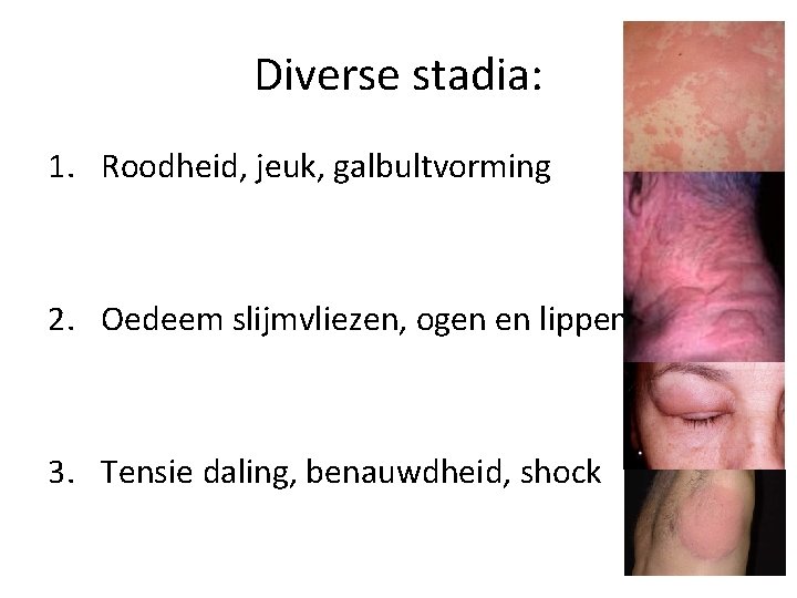 Diverse stadia: 1. Roodheid, jeuk, galbultvorming 2. Oedeem slijmvliezen, ogen en lippen 3. Tensie