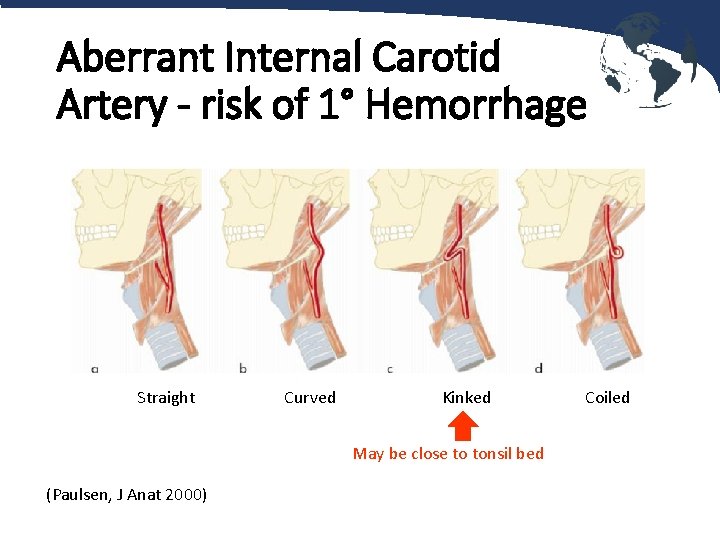 Aberrant Internal Carotid Artery - risk of 1° Hemorrhage Straight Curved Kinked May be