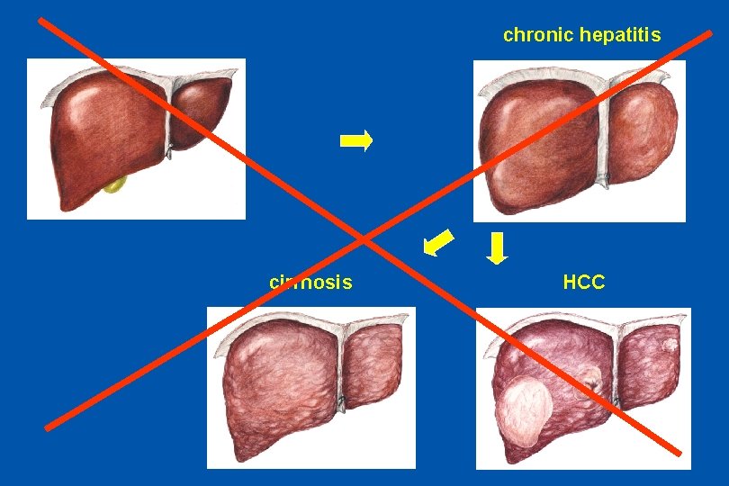 chronic hepatitis cirrhosis HCC ODTA Chorzów 