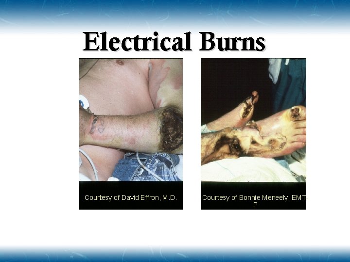 Electrical Burns Courtesy of David Effron, M. D. Courtesy of Bonnie Meneely, EMTP 