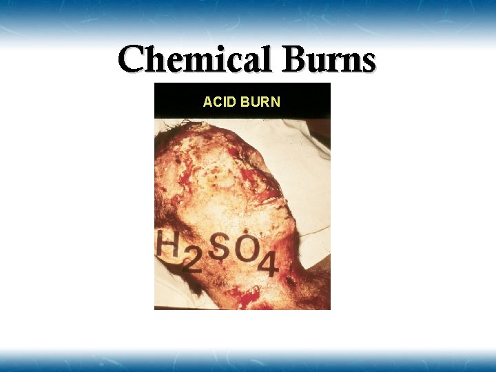 Chemical Burns ACID BURN 