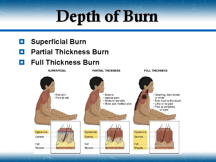 Depth of Burn ¥ Superficial Burn ¥ Partial Thickness Burn ¥ Full Thickness Burn