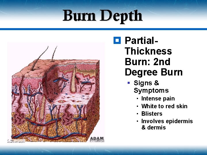 Burn Depth ¥ Partial. Thickness Burn: 2 nd Degree Burn § Signs & Symptoms