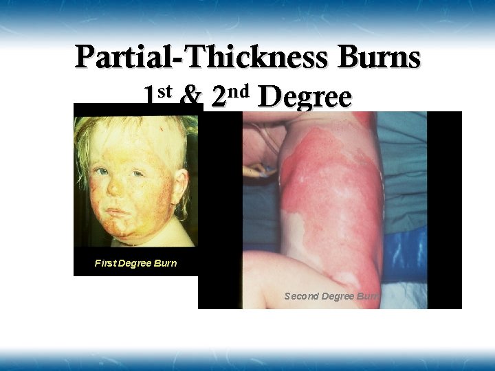 Partial-Thickness Burns 1 st & 2 nd Degree First Degree Burn Second Degree Burn
