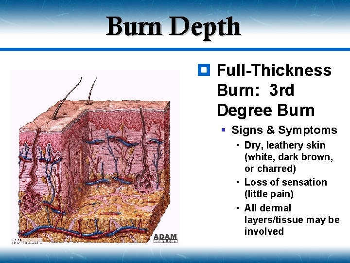 Burn Depth ¥ Full-Thickness Burn: 3 rd Degree Burn § Signs & Symptoms Dry,