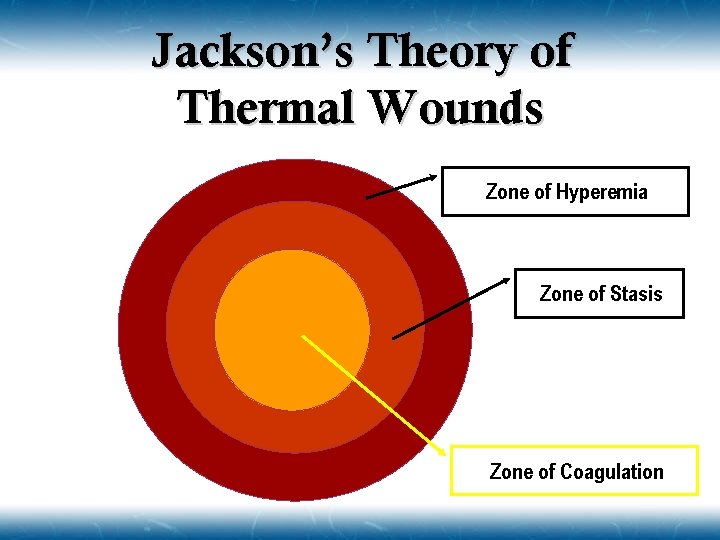 Jackson’s Theory of Thermal Wounds Zone of Hyperemia Zone of Stasis Zone of Coagulation