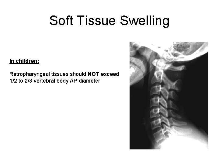 Soft Tissue Swelling In children: Retropharyngeal tissues should NOT exceed 1/2 to 2/3 vertebral