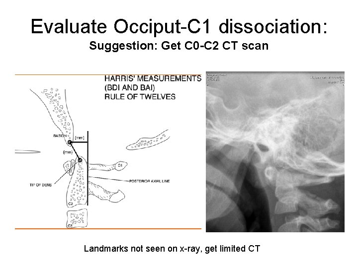 Evaluate Occiput-C 1 dissociation: Suggestion: Get C 0 -C 2 CT scan Landmarks not