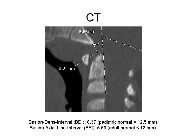 CT Basion-Dens-Interval (BDI): 8. 37 (pediatric normal < 12. 5 mm) Basion-Axial Line-Interval (BAI):