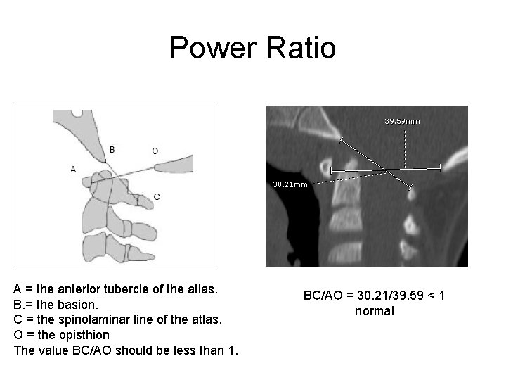 Power Ratio A = the anterior tubercle of the atlas. B. = the basion.