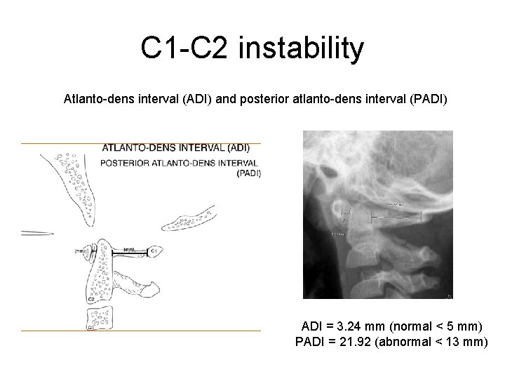 C 1 -C 2 instability Atlanto-dens interval (ADI) and posterior atlanto-dens interval (PADI) ADI