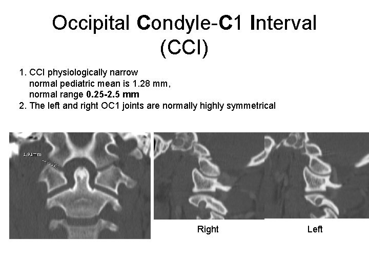 Occipital Condyle-C 1 Interval (CCI) 1. CCI physiologically narrow normal pediatric mean is 1.