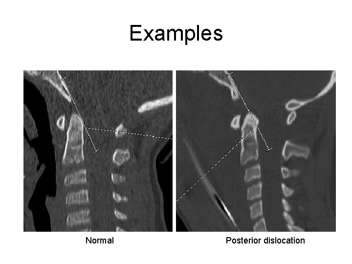 Examples Normal Posterior dislocation 