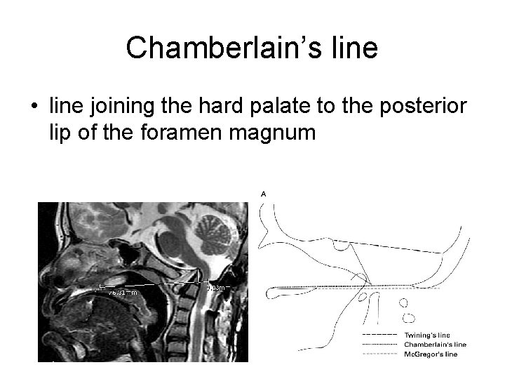 Chamberlain’s line • line joining the hard palate to the posterior lip of the