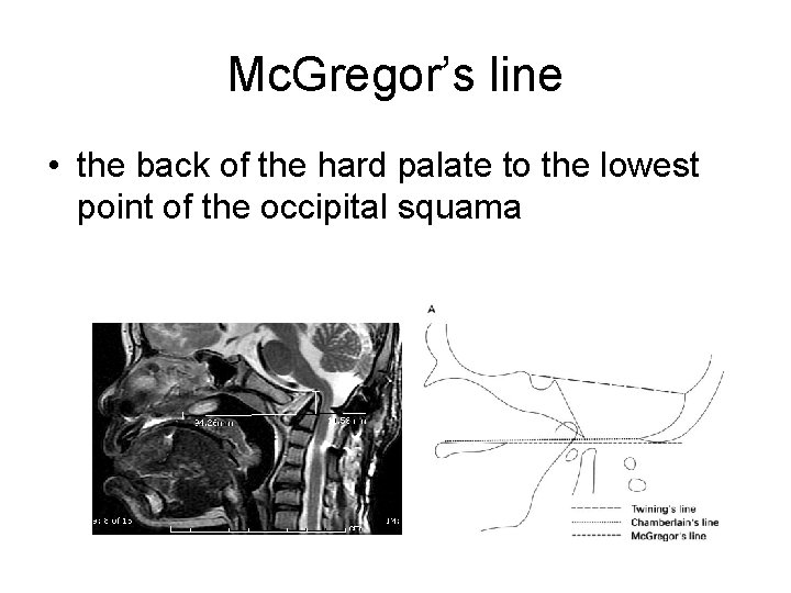 Mc. Gregor’s line • the back of the hard palate to the lowest point