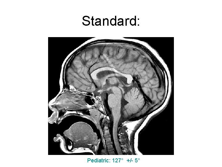 Standard: Pediatric: 127° +/- 5° 