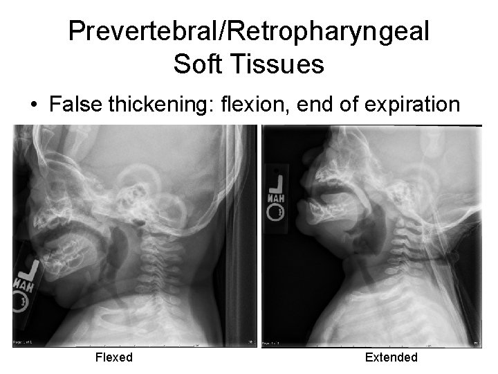 Prevertebral/Retropharyngeal Soft Tissues • False thickening: flexion, end of expiration Flexed Extended 