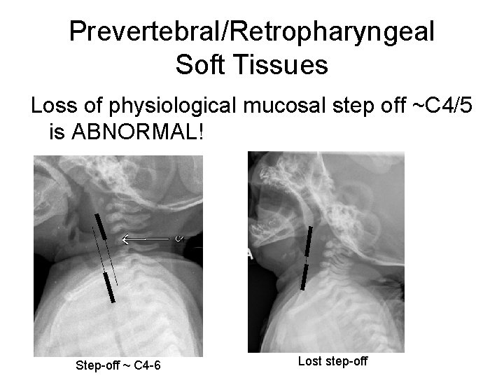 Prevertebral/Retropharyngeal Soft Tissues Loss of physiological mucosal step off ~C 4/5 is ABNORMAL! Step-off