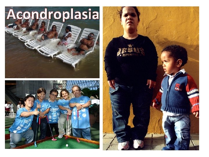 Acondroplasia 